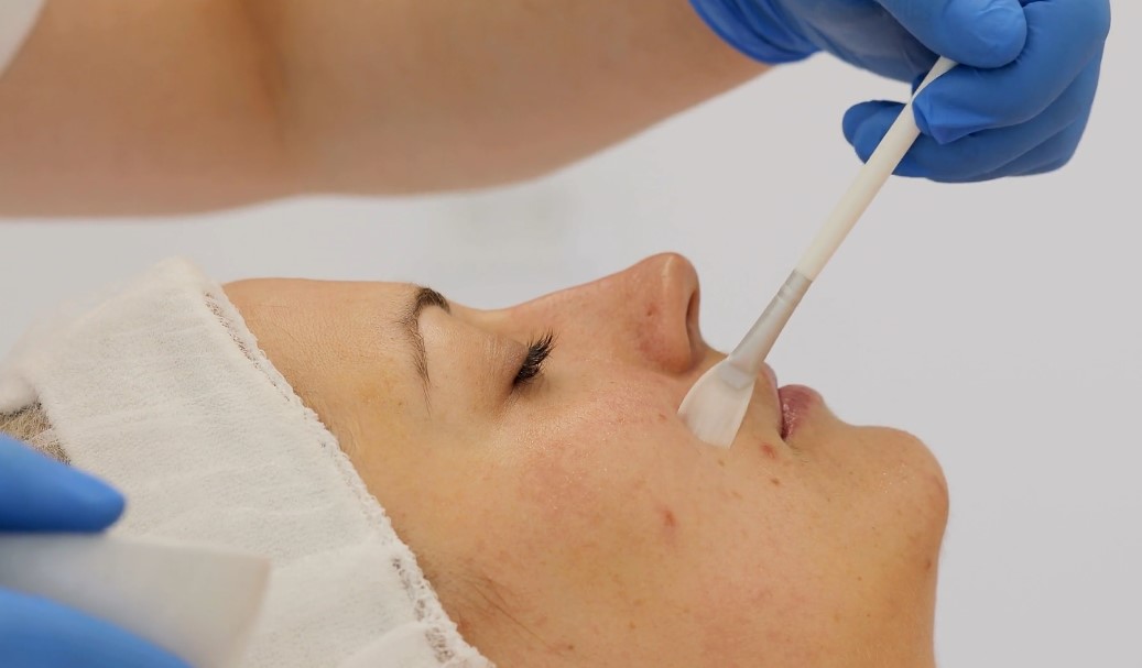 Woman receiving chemical exfoliation